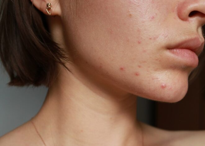 How Do I Know If My Acne Is Hormonal?