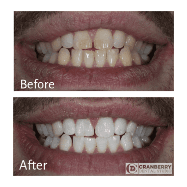 Teeth Whitening Gallery: Before and After
