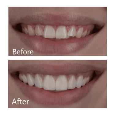 See Amazing Veneers Before-and-After Photos See Amazing Veneers Before-and-After Photos
