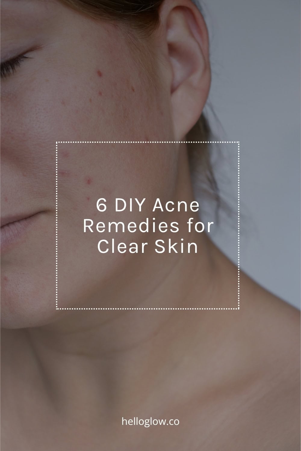 6 Easy, All-Natural DIY Acne Remedies