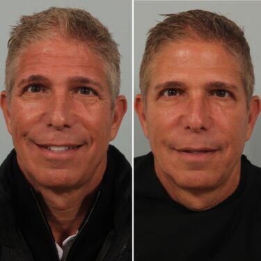 Male Injectables Before-and-After Photos: Botox and Filler Male Injectables Before-and-After Photos: Botox and Filler