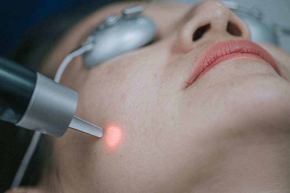 Can Laser Treatments Really Help Prevent Skin Cancer?