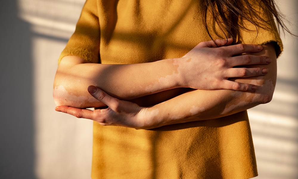 6 Things You Didn’t Know About Vitiligo 6 Things You Didn’t Know About Vitiligo