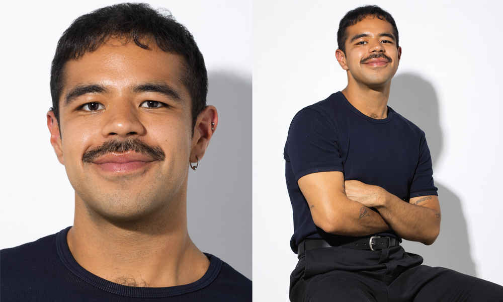 Back to Hair, Back to Me: A Hair Restoration Story